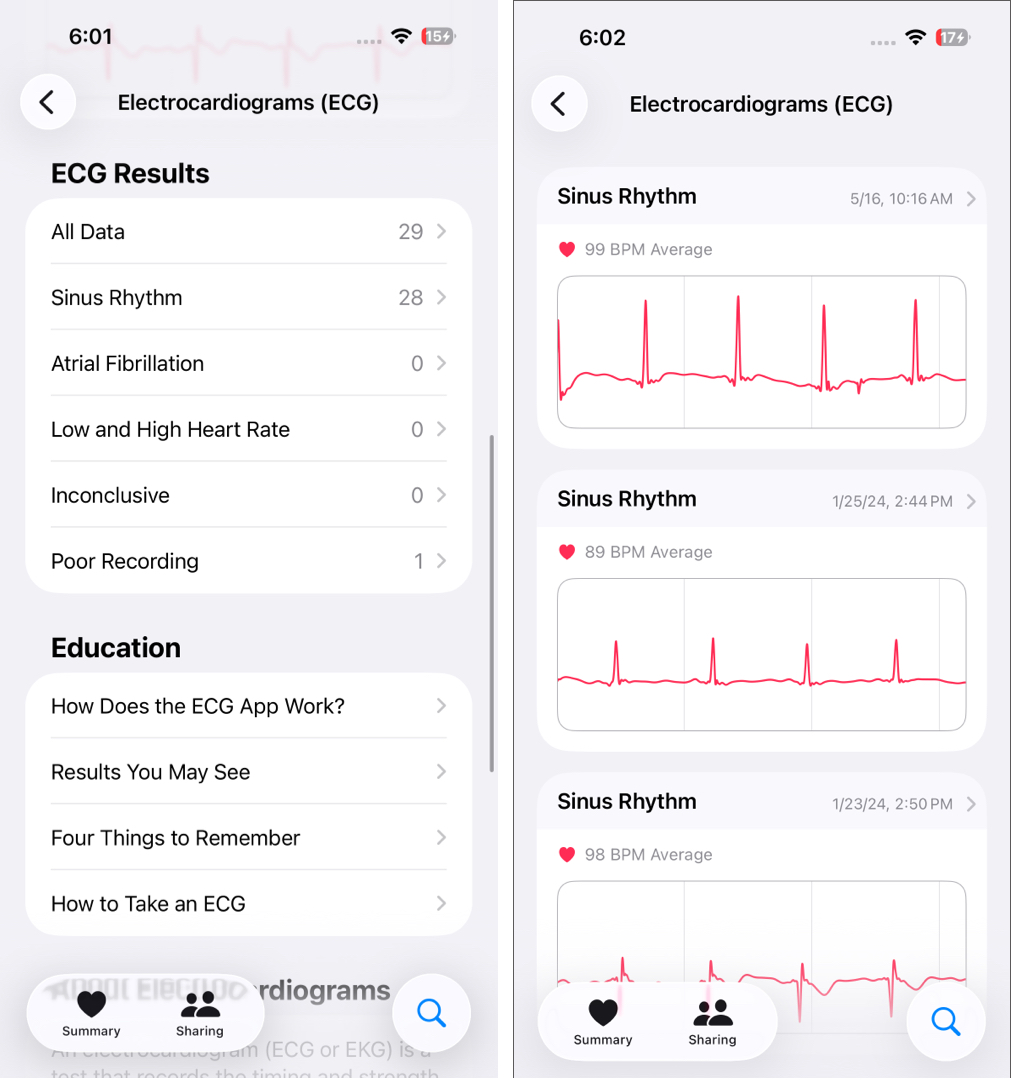 Understanding Apple Watch ECG Results and What They Mean